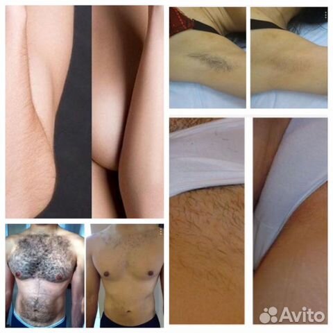 Лазерная эпиляция Лазерная эпиляция
