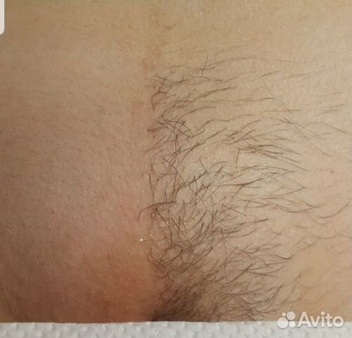 Депиляция Депиляция