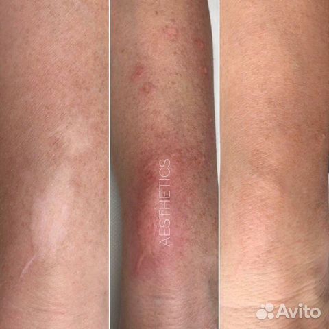 Реконструктивная дермопигментация